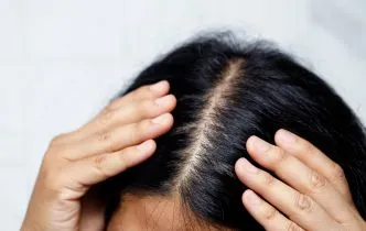 Common Hair Diseases