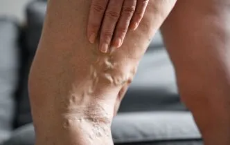 varicose veins webinar