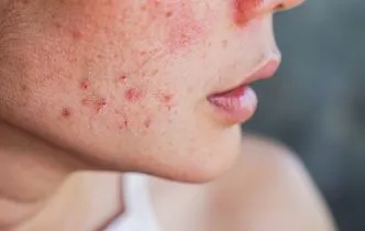 Webinar Acne Update